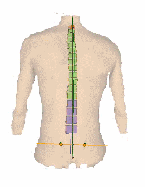 DIERS 4Dmotion: Dynamic 3D-Spine Model