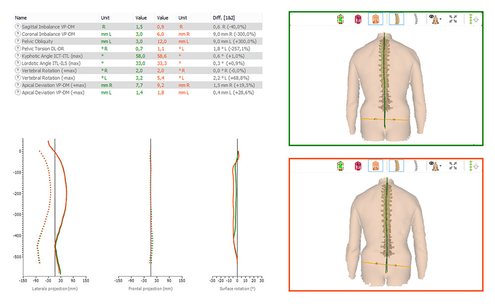 Pelvic Obliquity (Comparison)