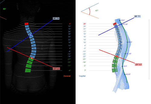 DICAM3-Add-on: scoliosis angle